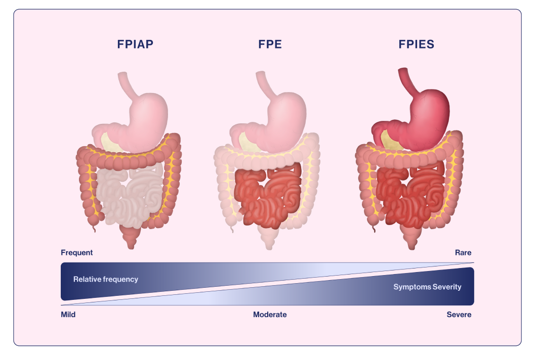 Gastrointestinal organs affected in the different non-IgE -mediated gastrointestinal food allergies: FPIAP, FPE and FPIES.